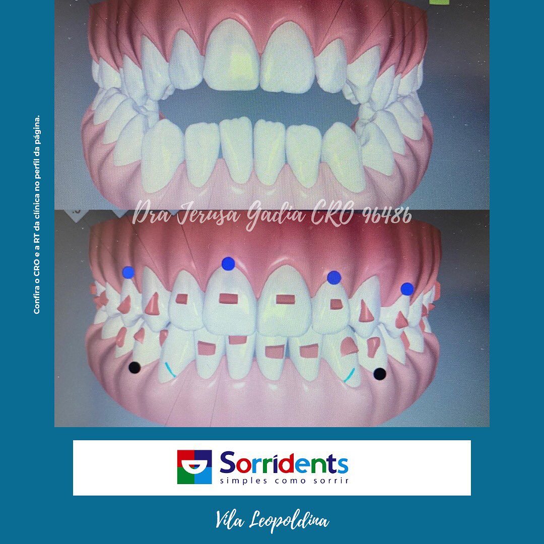 Resultado de tratamento odontológico antes e depois - Sorridents Vila Leopoldina