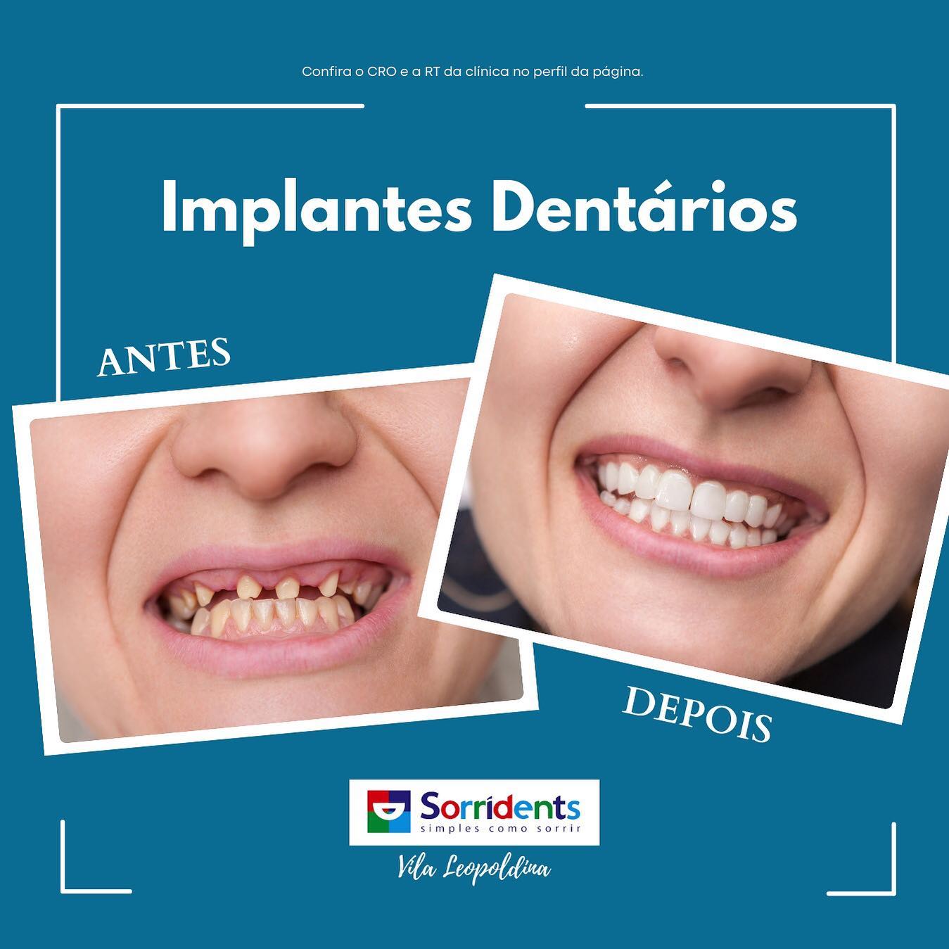 Transformação odontológica antes e depois - Sorridents Vila Leopoldina