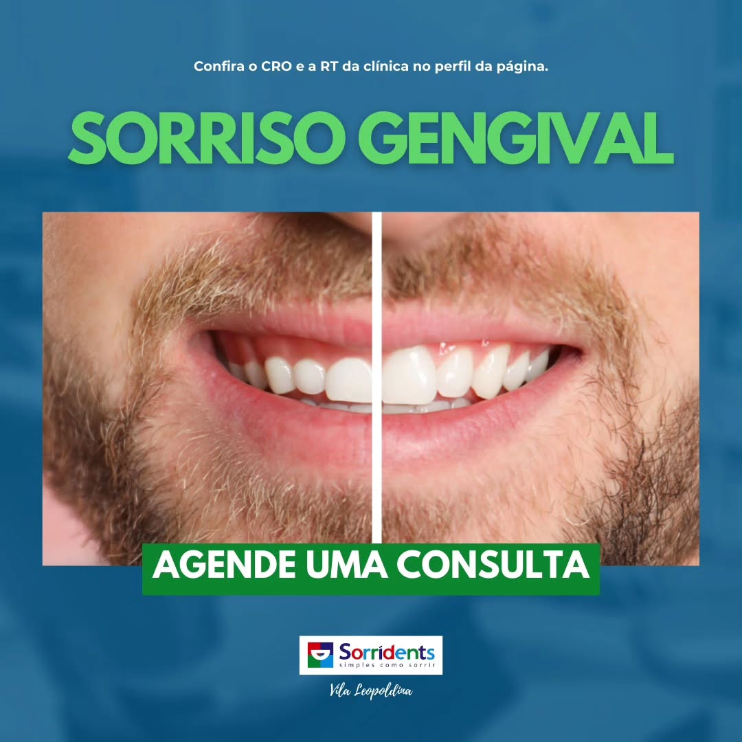 Transformação do sorriso antes e depois - Sorridents Vila Leopoldina