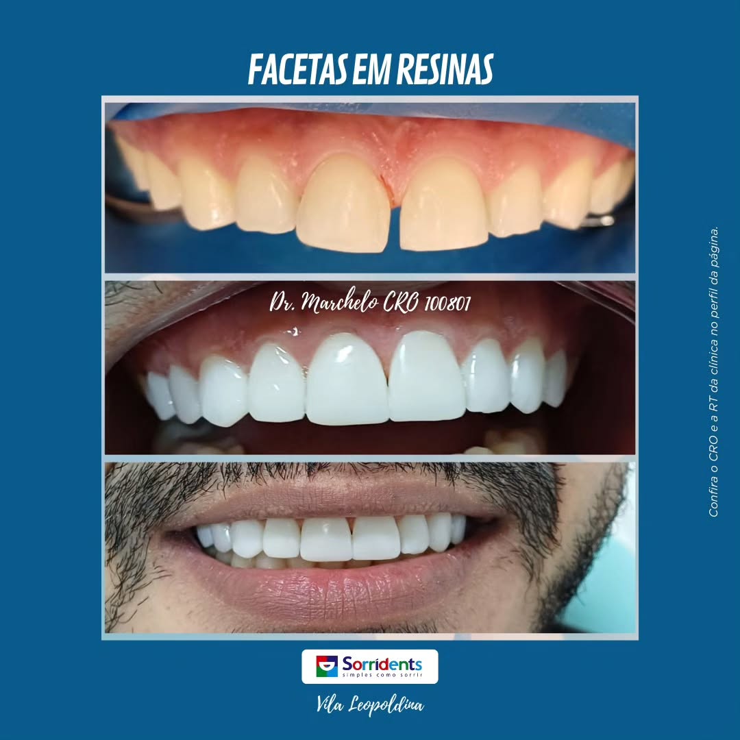 Resultado de tratamento dental antes e depois na Sorridents