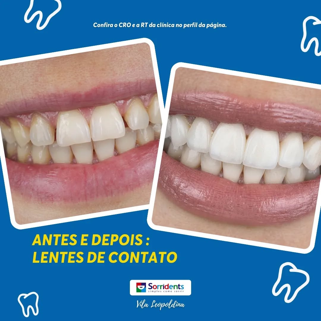 Transformação odontológica completa antes e depois - Sorridents Vila Leopoldina