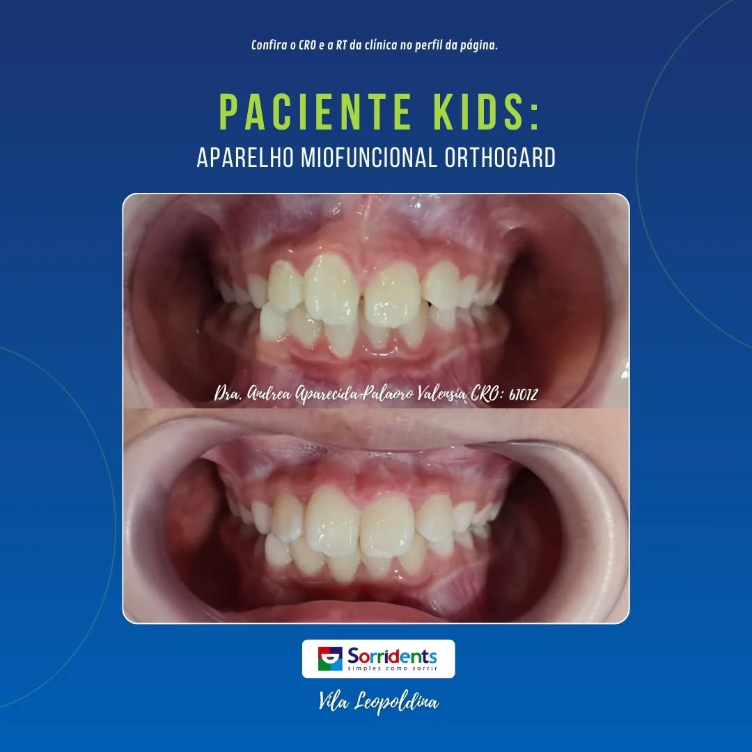 Resultado de procedimento odontológico antes e depois na clínica Sorridents