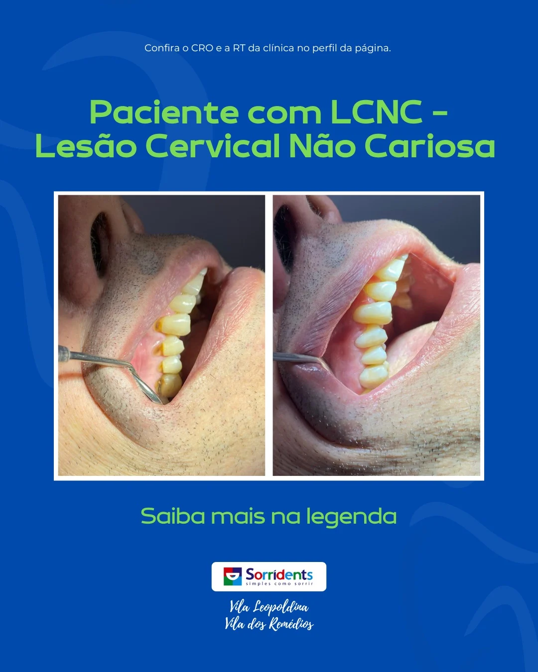 Resultado de tratamento odontológico antes e depois na Sorridents Vila Leopoldina