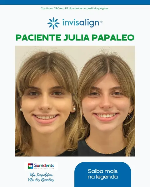 Transformação dental antes e depois - Sorridents clínica odontológica Vila Leopoldina
